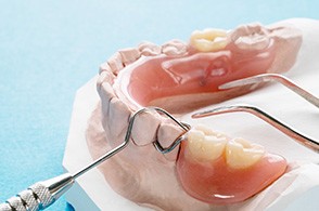 Partial denture on model of teeth