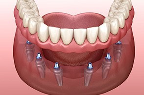 Illustration of full implant denture