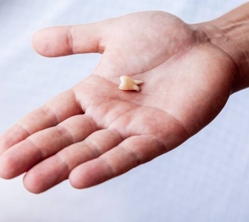 Extracted tooth resting in person’s hand