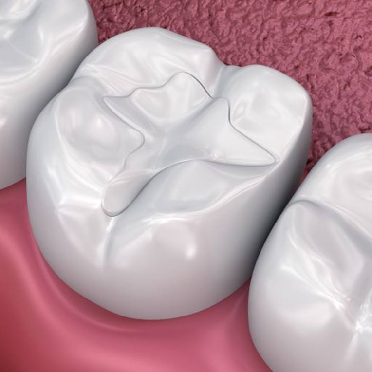 Illustration of tooth-colored filling on tooth’s chewing surface