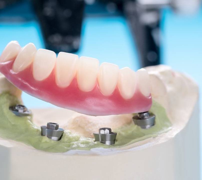 Model of an implant denture