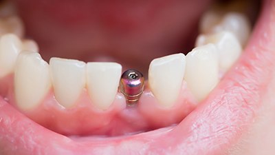 woman smiling with dental implant in mouth