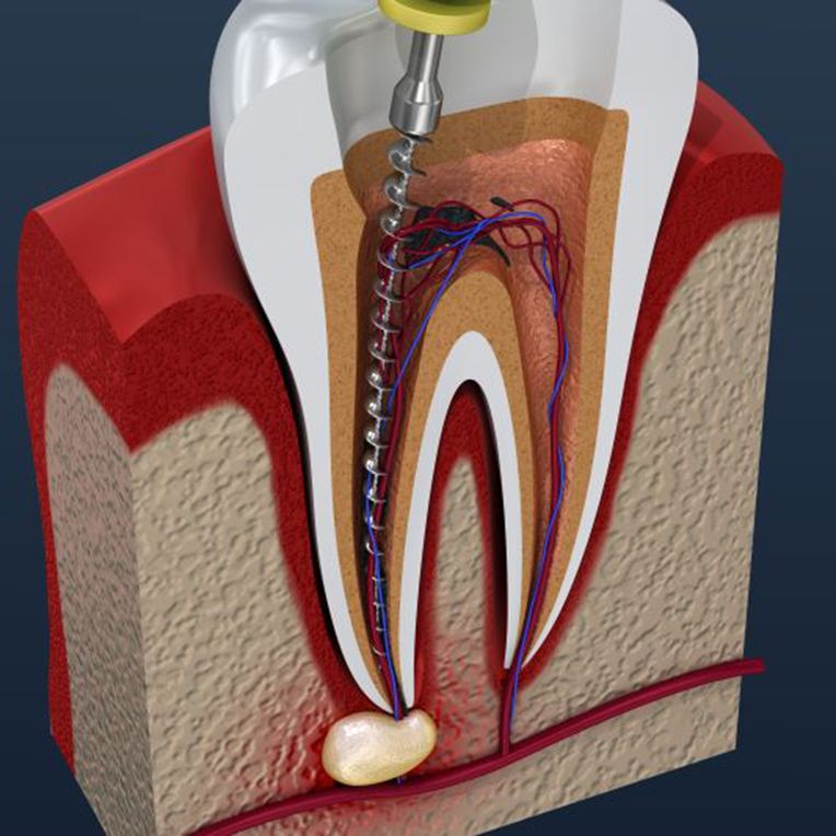 Illustration of instrument being used during root canal therapy