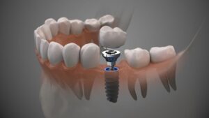 Illustration of implant post, abutment, and crown between natural teeth